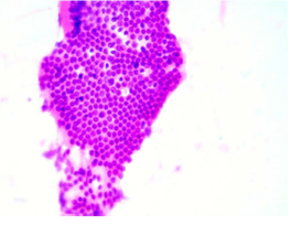 C&eacute;lulas ductales pancreaticas benignas. Se evidencia una monocapa de c&eacute;lulas ductales pancre&aacute;ticas, con aspecto de panal de abejas, n&uacute;cleos redondeados y limites citopl&aacute;smicos bien definidos. Hematoxilina y eosina, 40X.