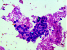 Adenocarcinoma ductal de p&aacute;ncreas moderadamente diferenciado. Se observa un grupo de c&eacute;lulas ductales con variaci&oacute;n de los tama&ntilde;os nucleares y ligero aumento de la relaci&oacute;n n&uacute;cleo-citoplasma (flecha azul), nucl&eacute;olos (flecha anaranjada), espaciamiento irregular y contornos nucleares irregulares (flecha verde). Hematoxilina y eosina, 40X.