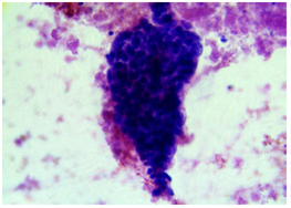 Adenocarcinoma ductal de p&aacute;ncreas moderadamente diferenciado. Se evidencia un conglomerado de c&eacute;lulas ductales que presenta tridimensionalidad y superposici&oacute;n nuclear. Hematoxilina y eosina, 40X.