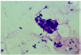 Adenocarcinoma ductal de p&aacute;ncreas moderadamente diferenciado. Se observa un conglomerado de c&eacute;lulas ductales con apariencia desordenada, marcada anisonucleosis, moderado pleomorfismo nuclear e hipercromasia. Hematoxilina y eosina, 40X.