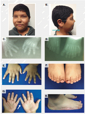 Caracter&iacute;sticas fenot&iacute;picas del individuo con s&iacute;ndrome de Bardet Biedl. A. Fotograf&iacute;a frontal: se observa un di&aacute;metro bitemporal estrecho, cejas gruesas arqueadas, hendiduras palpebrales elongadas, estrabismo, surco nasolabial largo, mejillas llenas y ment&oacute;n puntiforme. B. Fotograf&iacute;a lateral: la flecha se&ntilde;ala acantosis pigmentaria en el cuello. C. Radiograf&iacute;as de las manos a los dos a&ntilde;os de edad: se observa polidactilia posaxial en la mano izquierda. D. Radiograf&iacute;as de los pies a los dos a&ntilde;os de edad: se observa polidactilia posaxial bilateral. E y G. Manos: se observa braquidactilia y clinodactilia del quinto dedo en ambas manos, la flecha indica polidactilia posaxial de tipo ap&eacute;ndice cut&aacute;neo en la mano derecha. F y H. Pies: u&ntilde;as displ&aacute;sicas cortas y cicatrices laterales antiguas de la correcci&oacute;n de la polidactilia. Las fotograf&iacute;as A y B, y E a H, fueron tomadas a los 13 a&ntilde;os de edad, despu&eacute;s de la firma de los consentimientos informados.