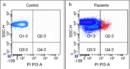 Gr&aacute;fica bivariada que ilustra la resoluci&oacute;n de fluorescencia de la subpoblaci&oacute;n celular RETCD71+: a) en sangre perif&eacute;rica de un voluntario sano, y b) en un paciente con glioma antes de iniciar el tratamiento