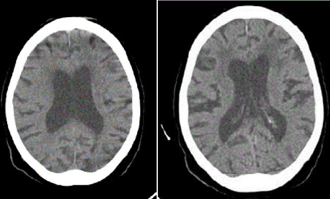 Tomografía computadorizada de cerebro: se observan hidrocefalia e hipodensidades periventriculares fronto-parietales.