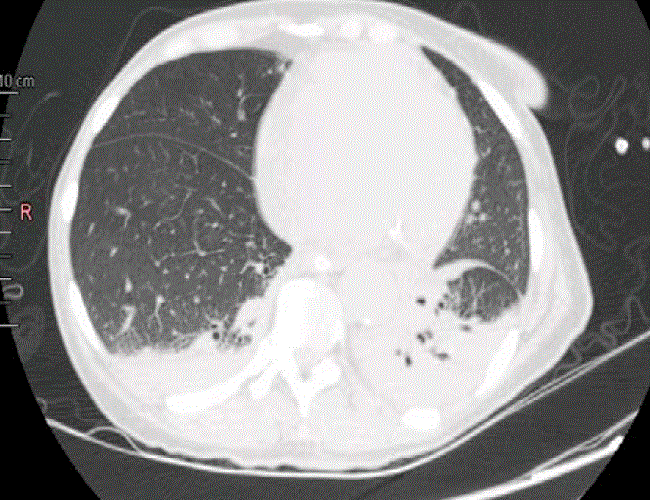 Tomografía computadorizada de tórax: patrón en vidrio esmerilado con atelectasia de lóbulo inferior pulmonar izquierdo