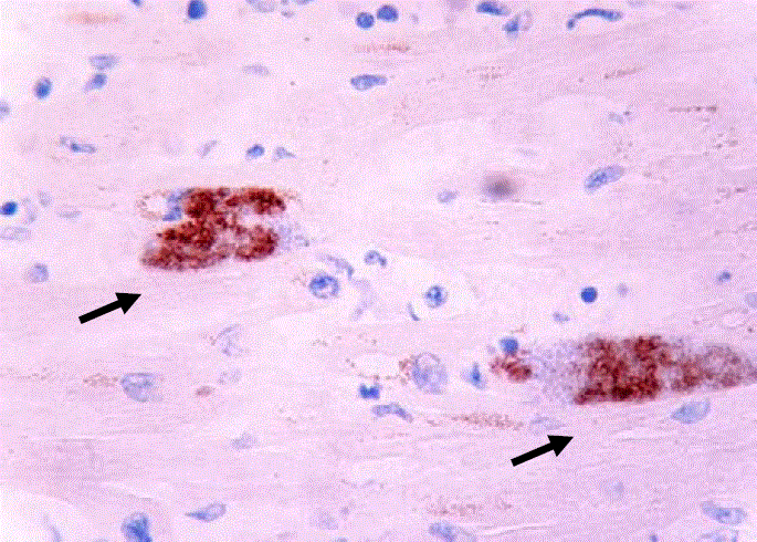 Estudio de inmunohistoquímica positivo para Toxoplasma gondii en músculo cardiaco (flecha), 40X