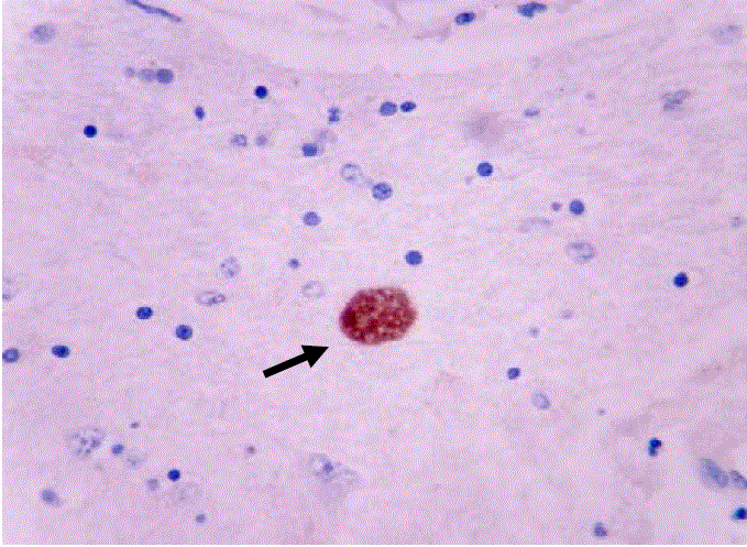 Estudio de inmunohistoquímica positivo para Toxoplasma gondii en cerebro (flecha). 40X