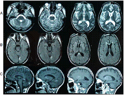 Resonancia magn&eacute;tica posterior a la hospitalizaci&oacute;n A. De izquierda a derecha: resoluci&oacute;n de edema cerebral, infartos &lsquo;lacunares&rsquo; en puente, n&uacute;cleos de la base y t&aacute;lamos. B. De izquierda a derecha: necrosis cortical laminar bilateral en corteza occipital (mayor compromiso izquierdo) y cambios en la se&ntilde;al del esplenio del cuerpo calloso (con gandolinio). C. De izquierda a derecha: infartos &lsquo;lacunares&rsquo; en ganglios de la base y necrosis cortical laminar de predominio occipital izquierdo (con contraste)