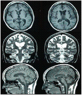 Resonancia magn&eacute;tica de control cinco a&ntilde;os despu&eacute;s del s&iacute;ndrome de embolia grasa. Se observan cambios retr&aacute;ctiles difusos en el par&eacute;nquima encef&aacute;lico, ventriculomegalia compensatoria y malacia occipital izquierda con gliosis