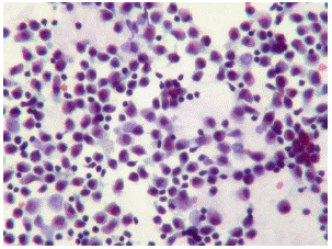 Lavado broncoalveolar con predominio (98 %) de macr&oacute;fagos alveolares. Papanicolau, 40X