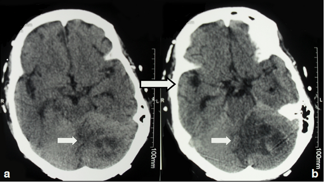 Dos cortes secuenciales (a y b) de la tomografía computarizada de cráneo. Se observa lesión de 36 x 43 mm en el hemisferio cerebeloso izquierdo, sugestiva de absceso cerebral (flecha)