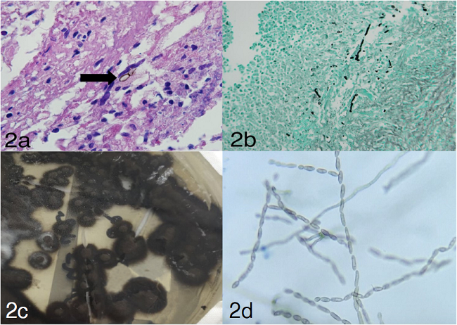a. La flecha muestra una hifa tabicada. Hematoxilina y eosina, 40X. b. Se observan estructuras fúngicas filamentosas. Plata metenamina, 20X. c. Cultivo en agar Sabouraud a 30 °C a las tres semanas de incubación: se observa crecimiento de moho negro. d. Presencia de conidias ovales que forman cadenas, características de C. bantiana. Microscopía de luz. 40X