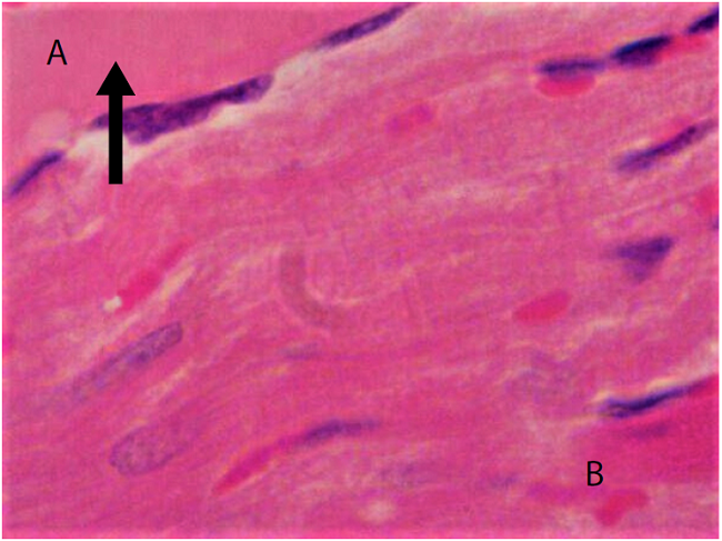 Necrosis por coagulación (A, flecha) en tejido cardiaco de Rattus rattus naturalmente infectado con Trypanosoma cruzi, capturado en un ambiente suburbano de Mérida, Yucatán, México. Nótese la diferencia con la parte de tejido sin daño (B). Hematoxilina y eosina, 100X