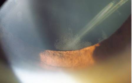 Lens opacity described as brown-cream deposits in the periphery of the anterior internal capsule of the lens observed in patient 2