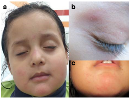 M&uacute;ltiples p&aacute;pulas rojas en: a) frente y dorso de la nariz; b) p&aacute;rpado superior; c) ment&oacute;n.