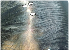 Costras hem&aacute;ticas en el cuero cabelludo (flechas)