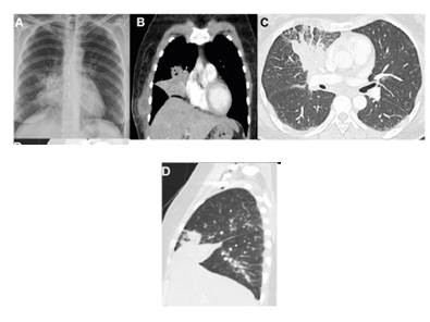 A. Radiografía de tórax. Opacidad paracardiaca derecha con signo de la silueta en la aurícula derecha. B, C y D. Tomografía computarizada de tórax. B. Reconstrucción coronal. Ventana de mediastino. Colección de la pared torácica en relación con el plano de los músculos intercostales y serrato derechos. Alteración en la densidad del tejido celular subcutáneo adyacente. Atelectasia del lóbulo medio. C. Corte axial, ventana de pulmón. Consolidación en el segmento anterior del lóbulo superior derecho asociada con aspecto en vidrio esmerilado y engrosamiento liso de tabiques interlobulillares. D. Reconstrucción sagital. Ventana de pulmón. Atelectasia del lóbulo medio. Consolidación en el segmento anterior del lóbulo superior derecho.