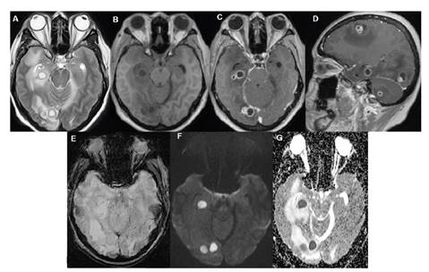 Resonancia magnética nuclear de cerebro con contraste. A. Imagen axial potenciada en T2 que demuestra lesiones multiloculadas e hiperintensas, con halo hipointenso en los lóbulos temporal y occipital derecho, indicativas de abscesos. Imagen axial en T1 precontraste (B) y coronal poscontraste (C) que demuestran el intenso realce anular delgado y la apariencia multilocular de las lesiones. D. Imagen sagital en T1 poscontraste que revela, además, el compromiso multifocal en la región supratentorial y otra lesión en el cerebelo derecho. E. Imagen axial potenciada en susceptibilidad magnética (Susceptibility-Weighted Image, SWI) que evidencia halo hipointenso delgado y completo, lo cual sugiere etiología inflamatoria. Imagen axial potenciada por difusión de resonancia magnética (Diffusion-Weighted Image, DWI), que pone en evidencia (F) la restricción central y homogénea en el interior de lo abscesos, confirmada por la baja señal en el correspondiente mapa del coeficiente de difusión aparente (Apparent Diffusion Coefficient, ADC) G.