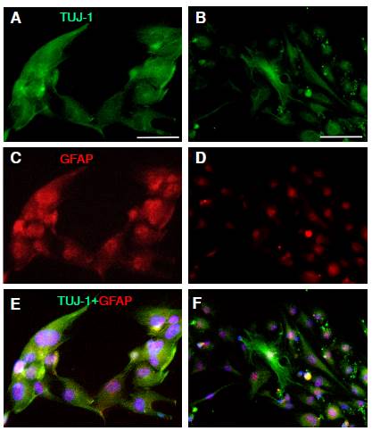 Human olfactory mucosa MSCs expressed protein for neurons and glial cells. MSCs were adapted to the lack of serum and seeded in DMEM/F12-GF until the spheres appeared and became confluent. Single cells from spheres were cultured in DMEM/F12-GF (A, C, E) and in DMEM/F12-RA+FORSK (B, D, F). TUJ-1 immunopositive cells were detected in stromal cells in DMEM/F12-GF (A, C, E)and in DMEM/F12-RA+ FORSK (B, E, F). Coexpression of TUJ-1 and GFAP was not different in DMEM/F12-GF (E) and in DMEM/ F12-RA+FORSK (F). Scale bar: 100 µm (A, B)
