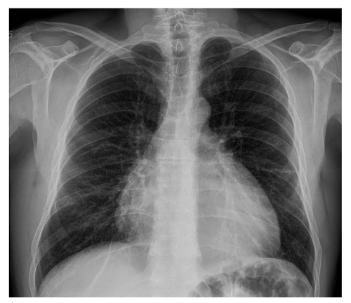 Chest X-ray. PA projection. Global cardiomegaly with rounded cardiac shape. No opacities were observed.