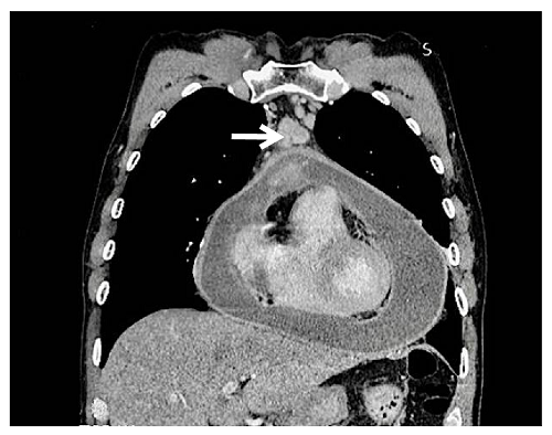 Contrasted chest computed tomography, mediastinal window. There is a 3-millimeter thickening and abnormal pericardial enhancement, pericardial effusion, which does not produce compression of the right ventricle, and pre-aortic adenopathy with heterogeneous enhancement (white arrow).