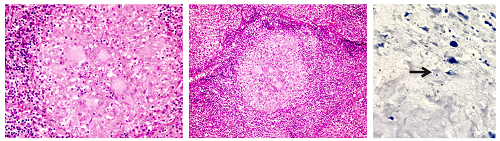 A and B. Pericardium compromised by chronic granulomatous inflammation with central necrosis and multinucleated giant cells. Hematoxylin-eosin. 40X. C. Zielh-Neelsen stain showing acid-fast bacilli (black arrow), 100X