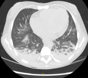 Tomograf&iacute;a computarizada de t&oacute;rax: &aacute;reas de consolidaci&oacute;n y atelectasias en ambos l&oacute;bulos inferiores