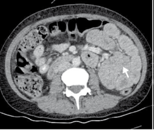 Tomograf&iacute;a computarizada de abdomen: dilataci&oacute;n del &iacute;leon distal, con engrosamiento de las paredes y signo de &ldquo;fecalizaci&oacute;n&rdquo; del contenido intraluminal (small-bowel feces sign), indicativos de posible obstrucci&oacute;n intestinal parcial