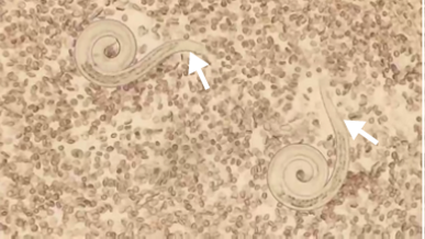 Extendido del lavado broncoalveolar: dos larvas correspondientes a Strongyloides stercoralis