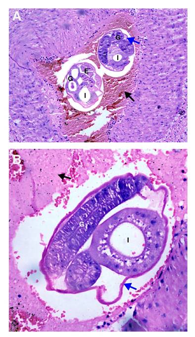 A and B. Mesenteric small artery with a thrombus (black arrow). Adult female worms cross-sectioned at different levels are observed inside. Note the cuticle (blue arrow), multinucleated intestine (I), and well-developed gonads (G) with eggs inside (E). Hematoxylin and eosin, 40X.
