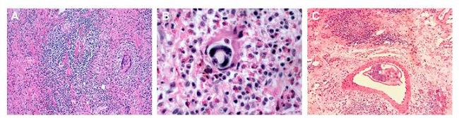 A. Colonic submucosa surrounded by intense eosinophilic inflammation and granulomatous reaction with giant multinucleated cells. B. Intestinal tissue surrounded by severe eosinophilic infiltration and a developing larva. C. Mesenteric tissue affected by granulomatous eosinophilic reaction; note a small artery containing an adult female worm. Hematoxylin and eosin, 40X.