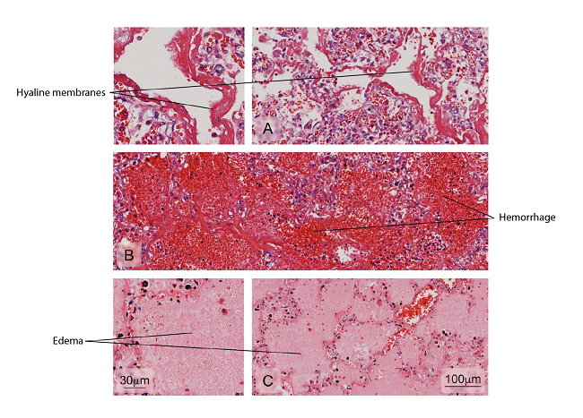 Alterations found in lung tissue of fatal dengue cases. Abnormal findings: A) Formation of hyaline membranes characteristic of diffuse alveolar damage (DAD); B) Severe hemorrhages in the alveoli; C) Presence of serous fluid in alveolar areas (edema). Hematoxylin and eosin stain