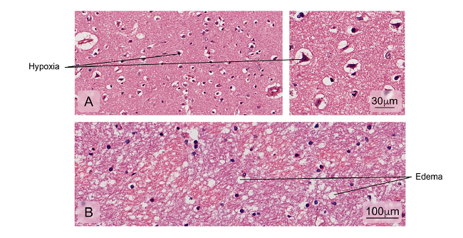 Alterations found in brain tissue-cerebral cortex. Some of the fatal cases presented:A) Decreased neuronal size due to retraction of the cytoplasm with nuclei pyknosis and hyperchromasia associated with hypoxic cortical changes; B) Edema. Hematoxylin and eosin stain.
