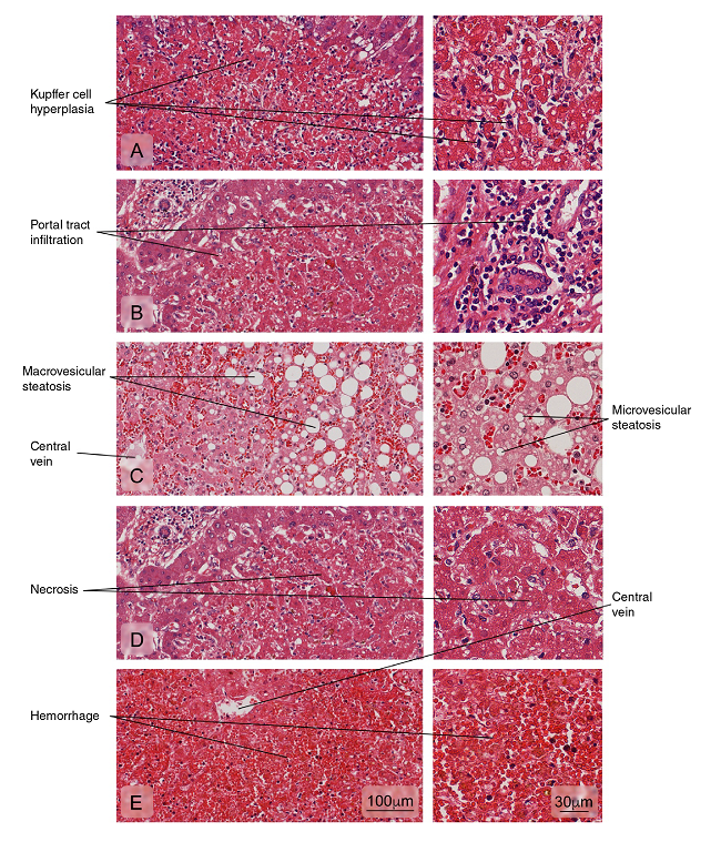 Alterations of the liver tissue showing: A) Kupffer cell hyperplasia; B) Portal tract leukocyte infiltration; C) Hepatic fatty degeneration (macro and microvesicular steatosis); D) An area of necrosis with loss of radial arrangement of hepatocyte plaques, a pale eosinophilic stain, and pyknotic or absent nuclei; E) Hemorrhages. Hematoxylin and eosin stain.