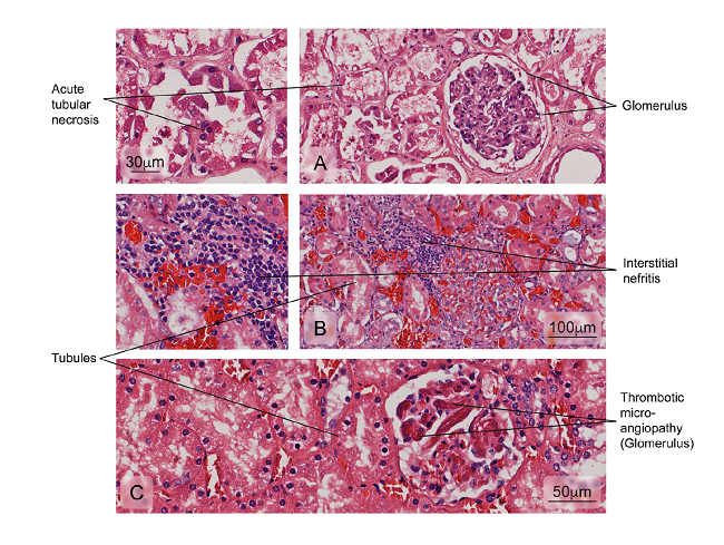 Alterations observed in renal tissue of cases. A) Necrosis of the tubular epithelium; B) Leukocyte infiltration of the interstitial space surrounding the renal tubules (interstitial nephritis), and C) Vascular lesions accompanied by intraluminal platelet thrombosis obstructing the vascular lumen (thrombotic microangiopathy). Hematoxylin and eosin stain. The heart