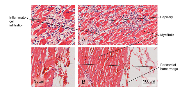 Aspect of cardiac muscle tissue in dead patients with anomalies. A) Inflammatory cell infiltration of the myocardium and B) pericardial hemorrhage. Hematoxylin and eosin stain.