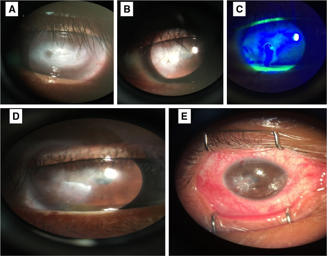 Im&aacute;genes correspondientes al caso 1 A) El ojo izquierdo con opacidad corneal densa del 70 % de la c&oacute;rnea que obstruye el eje visual y la irrigaci&oacute;n en dos cuadrantes. B) Ojo derecho antes de la cirug&iacute;a con opacidad e irrigaci&oacute;n corneal en el sector infero-temporal y descematocele con microperforaci&oacute;n corneal C) Ojo derecho antes de la cirug&iacute;a con signo de Seidel espont&aacute;neo D) Ojo derecho a los cuatro meses de la cirug&iacute;a. Se observa el parche corneal tect&oacute;nico bien integrado, con irrigaci&oacute;n y opacidad en el cuadrante infero-temporal que afecta parcialmente el eje visual, pupila normoc&oacute;rica, c&aacute;mara anterior formada y cristalino claro. E) Vista del parche corneal tect&oacute;nico en el ojo derecho inmediatamente despu&eacute;s de la cirug&iacute;a. Se observa el injerto tect&oacute;nico que sella la perforaci&oacute;n corneal.