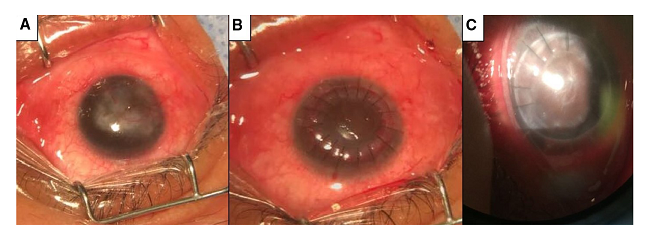 Im&aacute;genes correspondientes al caso 2 A) Ojo derecho antes de la cirug&iacute;a. Se observa opacidad corneal central con irrigaci&oacute;n en tres cuadrantes. No fue posible valorar los detalles del segmento anterior. B) Ojo derecho inmediatamente despu&eacute;s de la cirug&iacute;a. Se observa el injerto corneal in situ y restos del sangrado de los vasos corneales en interfase. C) Ojo derecho dos meses despu&eacute;s de la cirug&iacute;a. Se observa el injerto corneal in situ y opacidad central en interfase. En este momento ya se hab&iacute;an retirado algunos puntos de sutura.