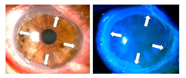 Six hours after the acid burn and after debridement of the necrotic tissue membrane covering the cornea, a remnant could be seen in the entire corneal periphery (white arrows). The de-epithelized area of the cornea is stained very slightly with fluorescein. In the remnant of the peripheral necrotic membrane, obvious fluorescence was observed when using the cobalt blue filter (right).