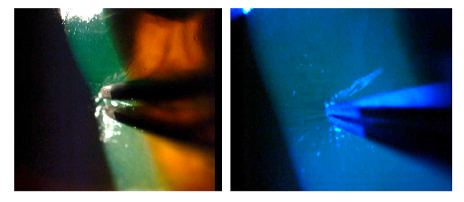 Attempting debridement over the central area of the cornea confirmed the absence of epithelium.