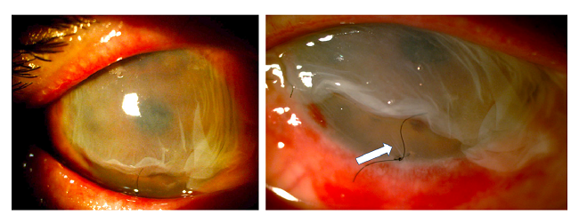 Graft with a double amniotic membrane covering the entire cornea and conjunctiva fixed with sutures and tissue glue and a retaining ring placed in the conjunctival cul-de-sac. Ten days later, the outermost membrane was in partial resorption but the amniotic membrane adjacent to the cornea remained in situ as confirmed by the presence of fine folds adjacent to the suture (white arrow) in the figure on the right.