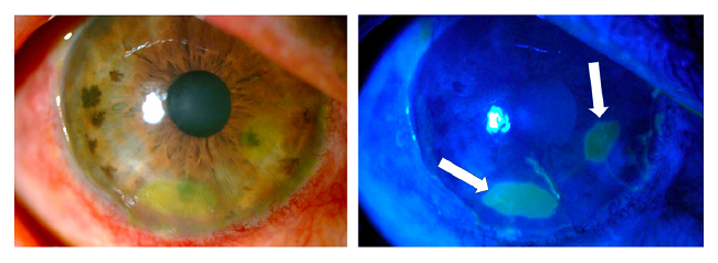 Three weeks after the burn, the amniotic membrane on the surface of the cornea had been reabsorbed and a healthy-looking epithelium was observed with only two oval de- epithelialization areas stained with fluorescein (arrows).