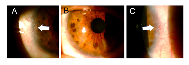 Two years after the burn, the cornea presented good transparency (B) and the conjunctival areas only involved two quadrants and showed significant regression (A and C).