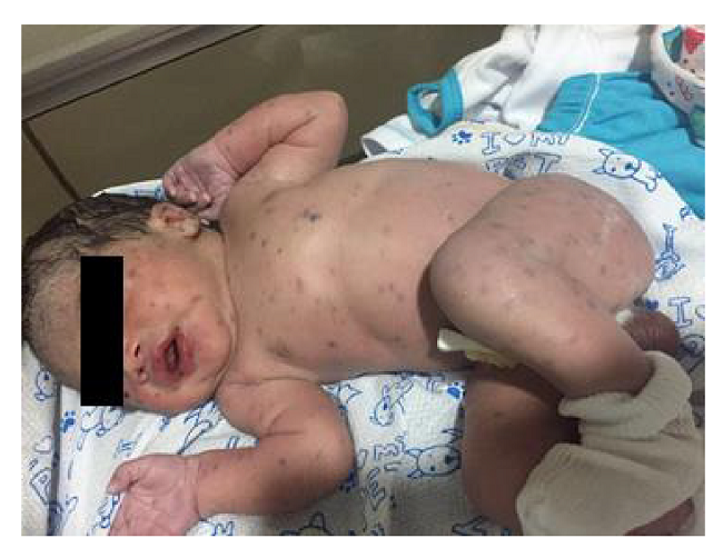 Histiocitosis de c&eacute;lulas de Langerhans del paciente a los pocos d&iacute;as de nacido. Lesiones en toda la superficie cut&aacute;nea en forma continua, principalmente en cara, abdomen, brazos y piernas, con caracter&iacute;sticas papulares viol&aacute;ceas, aproximadamente, de 0,5 cm de di&aacute;metro y sin afectaci&oacute;n de las mucosas