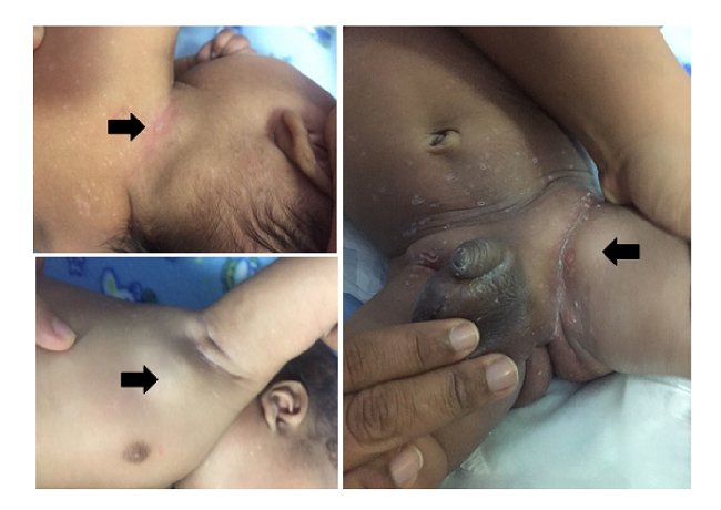 Histiocitosis de c&eacute;lulas de Langerhans del paciente al mes de vida. Lesiones hipocr&oacute;micas en toda la superficie corporal y adenopat&iacute;as generalizadas en las regiones cervical anterior, axilar e inguinal. Las flechas muestran adenopat&iacute;as de aproximadamente 2,5 cm en la regi&oacute;n cervical posterior, de 1 a 2 cm en la regi&oacute;n axilar izquierda y del mismo tama&ntilde;o en las dos zonas inguinales. Se observan en la piel lesiones generalizadas ves&iacute;culo-ampollosas del tipo de p&aacute;pulas descamativas.