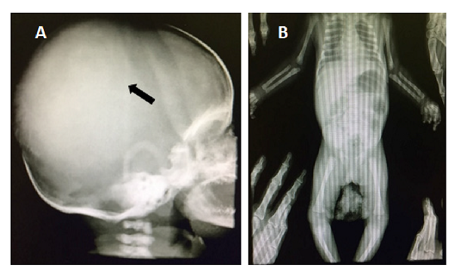 Radiograf&iacute;a de cr&aacute;neo y t&oacute;rax del paciente con histiocitosis de c&eacute;lulas de Langerhans. A. Radiograf&iacute;a de cr&aacute;neo que denota aumento del volumen de los huesos de la b&oacute;veda craneana y desproporci&oacute;n craneofacial. B. Radiograf&iacute;as normales de t&oacute;rax y huesos largos