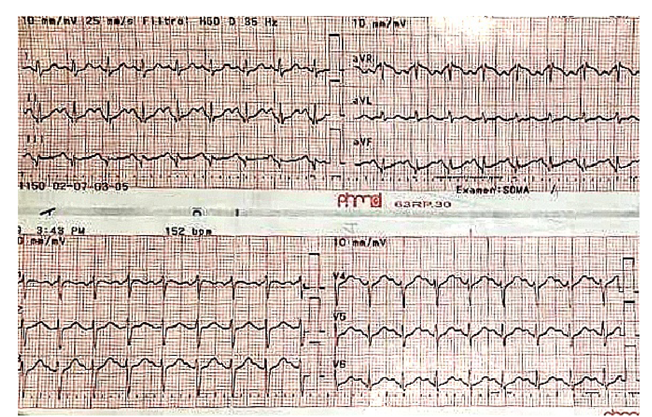 Taquicardia de complejos estrechos, regular, frecuencia card&iacute;aca de 150 latidos por minuto, eje normal, sin alteraciones en repolarizaci&oacute;n ni signos de isquemia mioc&aacute;rdica