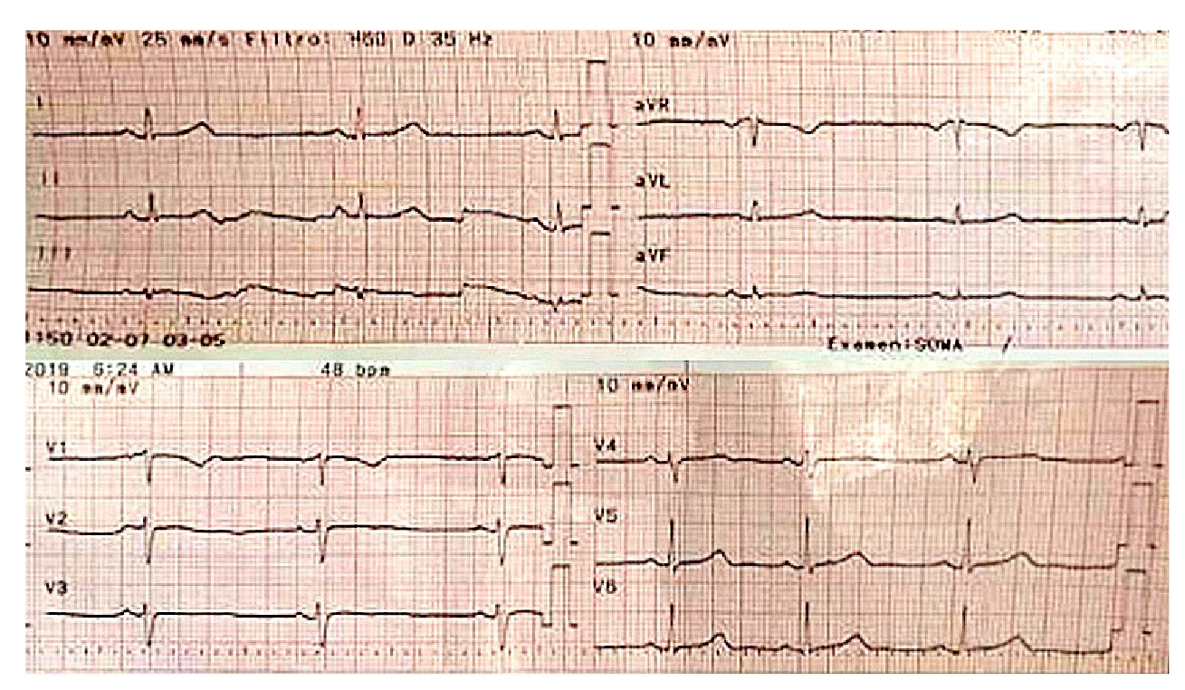 Bradicardia sinusal de 45 latidos por minuto, eje normal, sin signos de bloqueo aur&iacute;culo-ventricular ni trastorno de repolarizaci&oacute;n