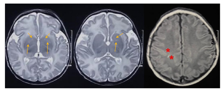 En la secuencia potenciada en 12 (primeras dos im&aacute;genes), se sugiere la presencia de secuelas por encefalopat&iacute;a hip&oacute;xico-isqu&eacute;mica en los n&uacute;cleos lenticulares (flechas). En la secuencia 11 (tercera imagen), se evidencian se&ntilde;ales puntiformes hiperintensas subcorticales en los l&oacute;bulos parietal y frontal derechos (asterisco).