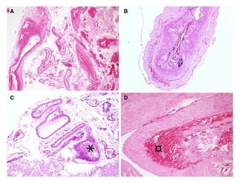 Resultados de la autopsia, microscop&iacute;a simple. A. Cortes de la arteria cerebral posterior que no muestran vasculitis. Hematoxilina y eosina, 10X. B. Arteria vertebral normal. Hematoxilina y eosina, 20X. C. Vasos arteriales leptomen&iacute;ngeos sin vasculitis, pero con foco vecino de hemorragia cortical (*). Hematoxilina y eosina, 10X. D. Corte de la duramadre con fondo hemorr&aacute;gico (&curren;). Hematoxilina y eosina, 20X.