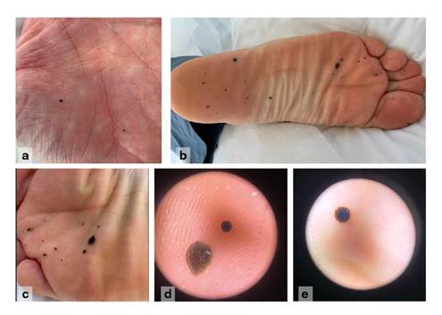 (a) Maculas caf&eacute;s, m&uacute;ltiples y bien definidas en la palma de la mano izquierda. (b-c) M&aacute;culas caf&eacute;s, m&uacute;ltiples y bien definidas en la planta izquierda. (d-e) M&aacute;cula hiperpigmentada, bien definida, sin red de pigmento en la dermatoscopia